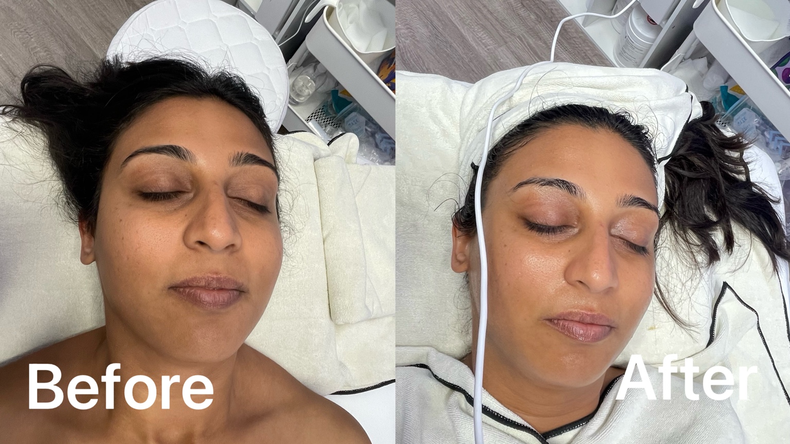 Complete before and after facial result showing a brighter, refreshed appearance