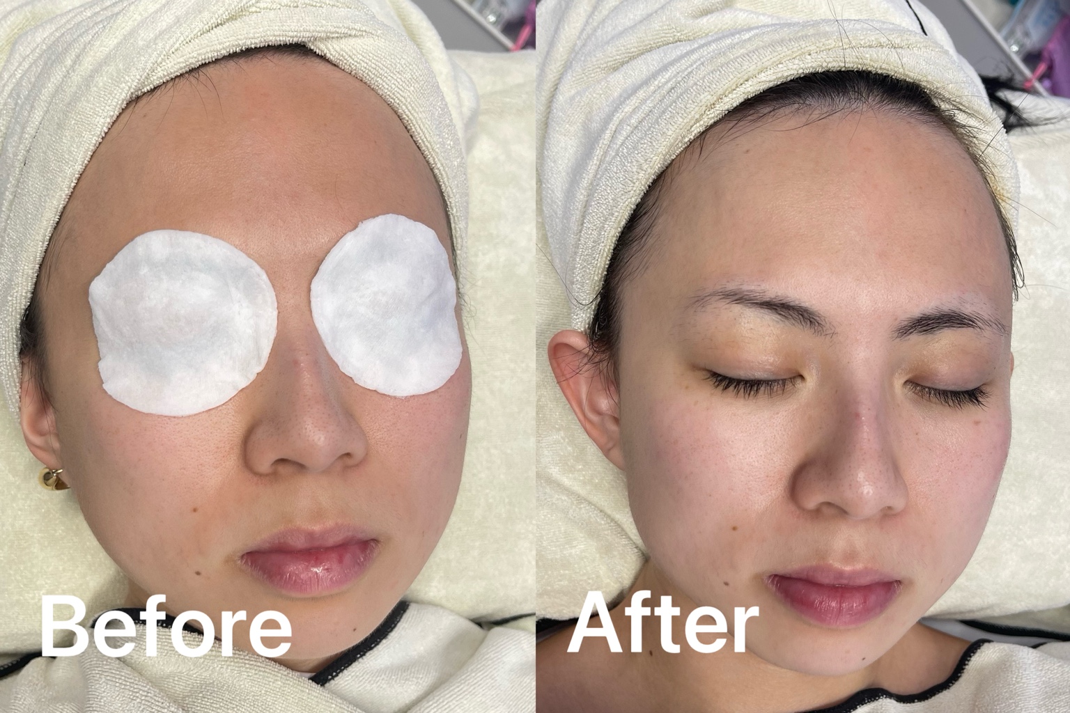 Before and after facial showing brighter-looking skin