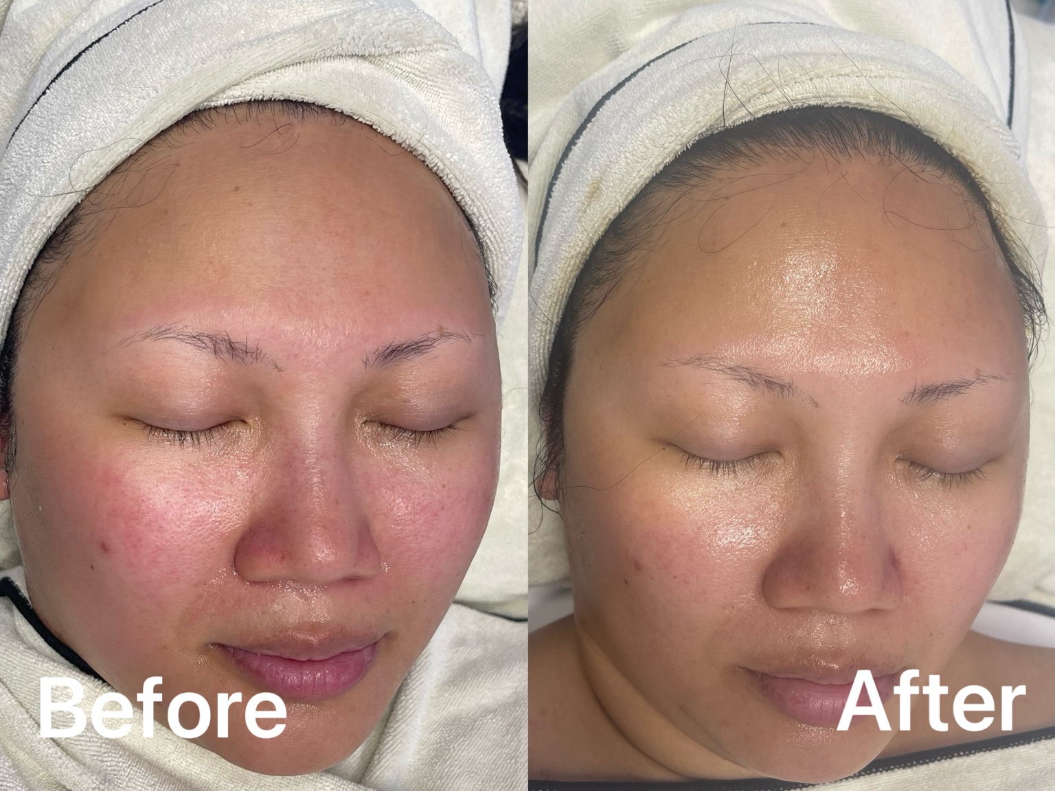 Before and after facial showing visibly calmer-looking skin