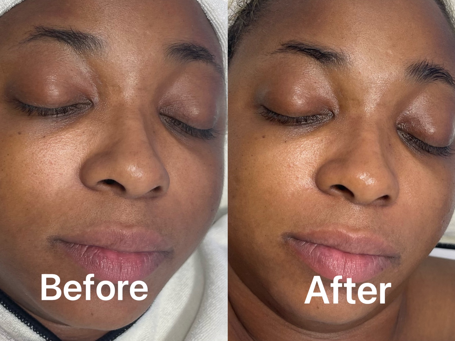 Before and after facial close-up showing a hydrated glow