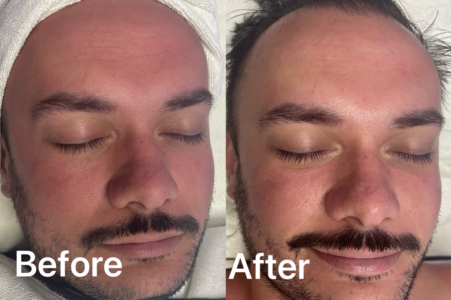 Before and after facial result for a male client